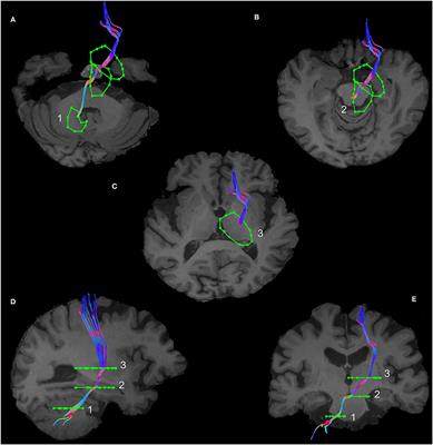 Investigating the Anatomy and Microstructure of the Dentato-rubro-thalamic and Subthalamo-ponto-cerebellar Tracts in Parkinson's Disease